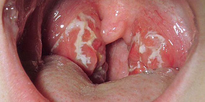 symtom på tonsillit