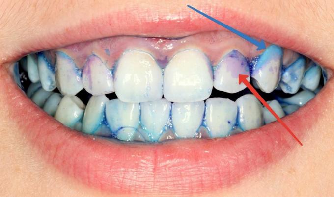 Hur ta hand om dina tänder