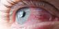 Konjunktivit: varför rodna ögonen och hur man behandlar dem