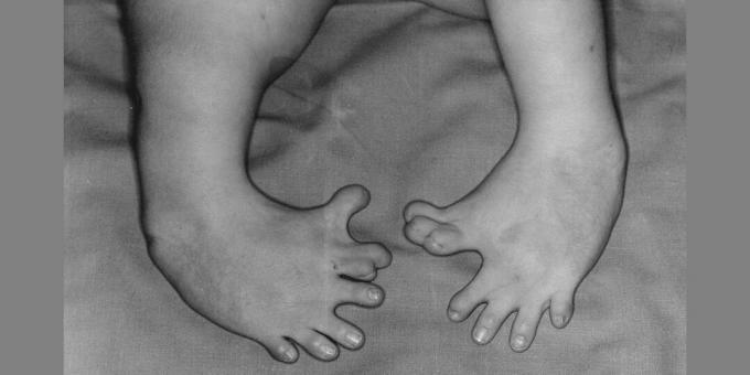 Deformitet i benen på en nyfödd vars mor tog talidomid. Biverkningarna av läkemedlet kallas ett exempel på åtgärder från Big Pharma.