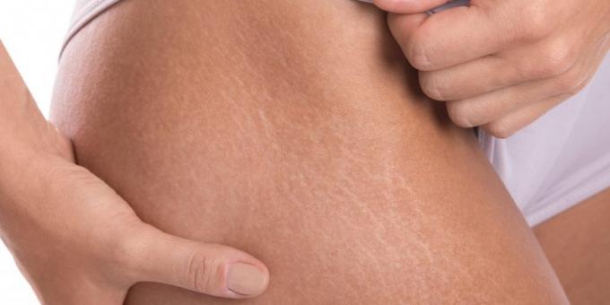 Hur man kan bli av med hudbristningar: Bristningar