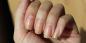 Varför gula naglar och hur man kan föra dem en hälsosam färg
