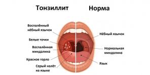 Kronisk tonsillit: symtom, komplikationer, behandling och mer