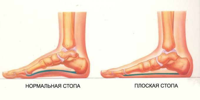 övningar för platta fötter: normal och platt fot