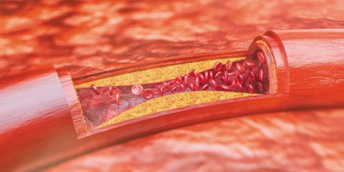 Kolesterol: aterosklerotiska plack