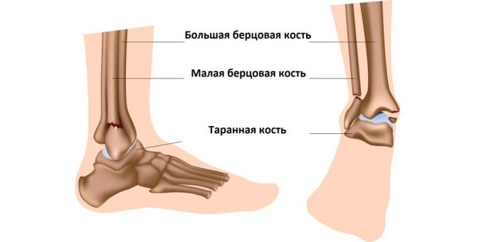 Ankelfraktur påverkar benen som utgör ankeln