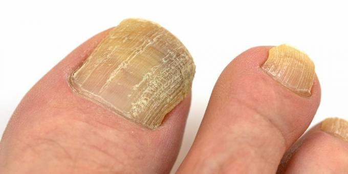 Dermatomykos: nagelsvamp