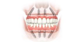 Hur återställa tänderna och le tillbaka
