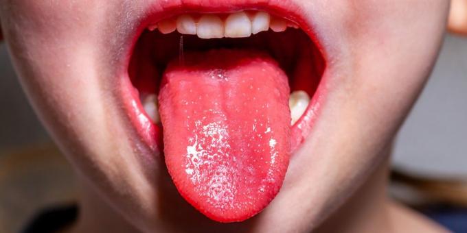 Scharlakansfeber Symptom: Strawberry Tongue