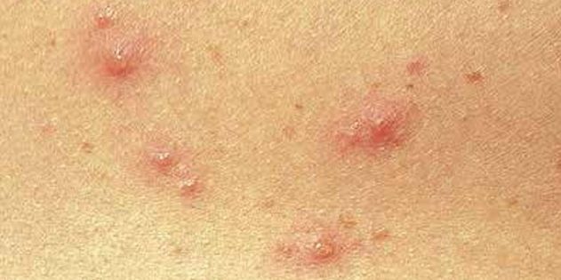 Symtom på vattkoppor hos barn och vuxna: Ganska ofta huden visas omedelbart små röda prickar