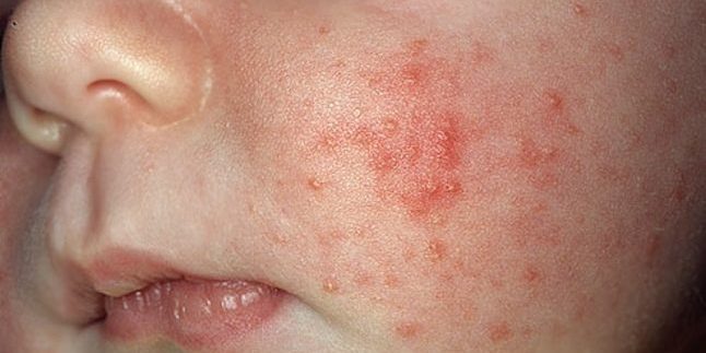 Hur man kan bli av med akne: Acne Infant