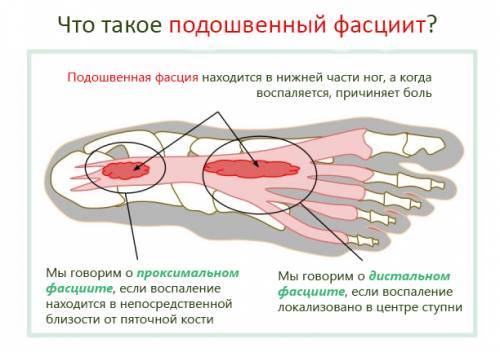 plantar fasciit